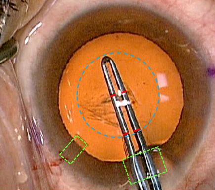 Master Techniques in Surgery: Vascular Surgery: Hybrid
